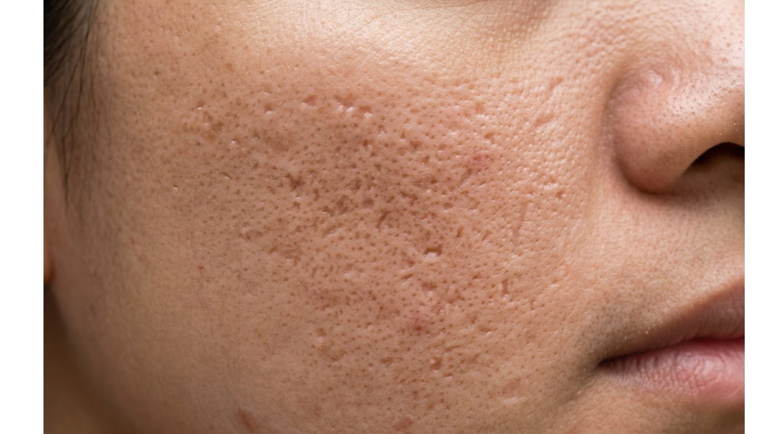 Acne scars & atrophic scarring