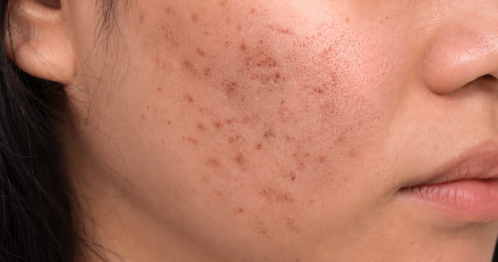Close-up of a cheek showing flat brown post-inflammatory marks left after acne