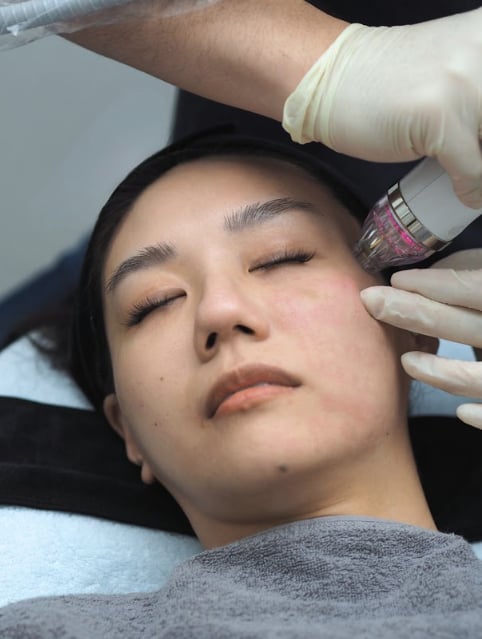 Doctor performing an RF microneedling treatment on a patient's cheek at Reborn Skin Clinic