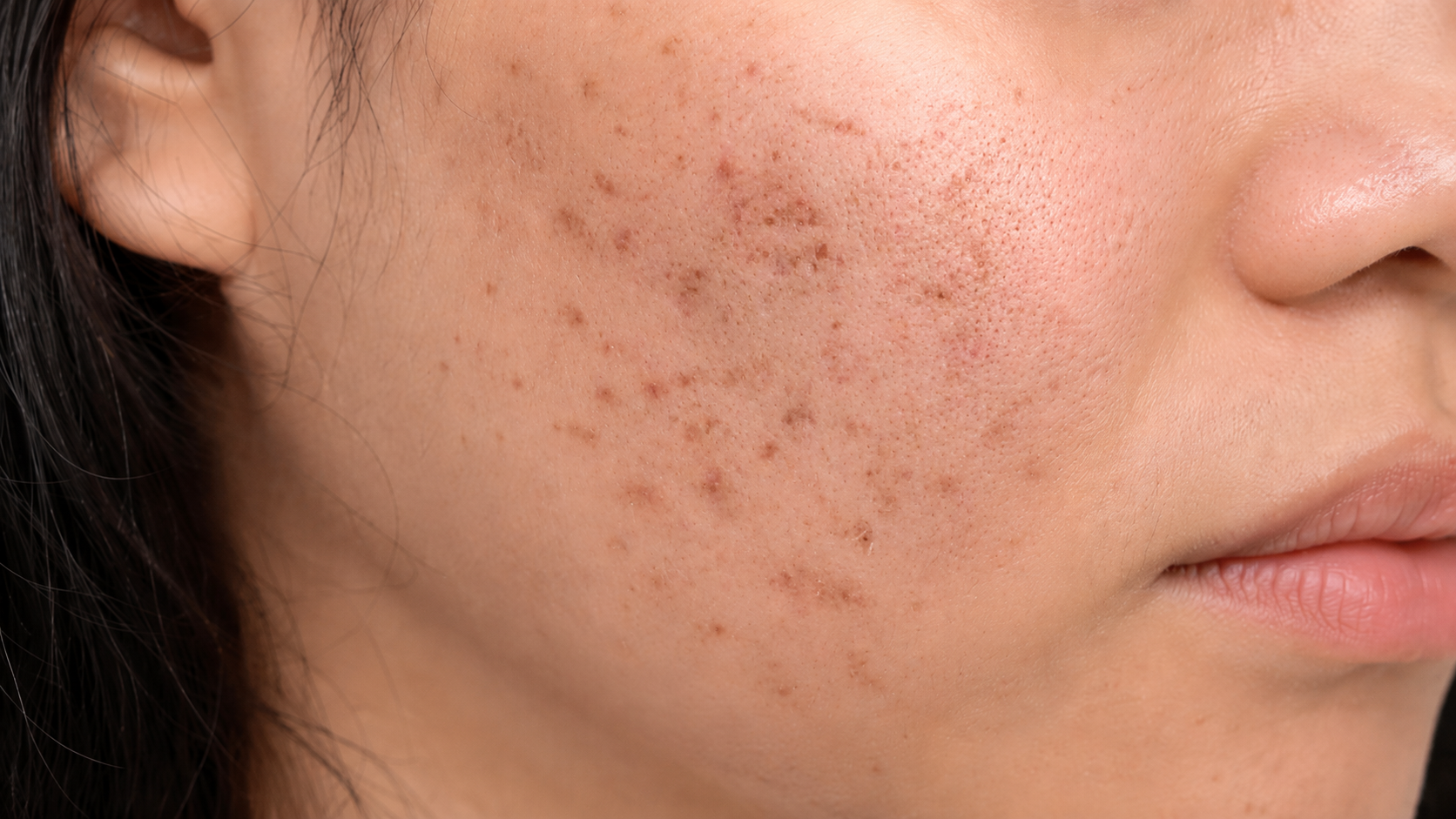 Pigmentation & uneven tone
