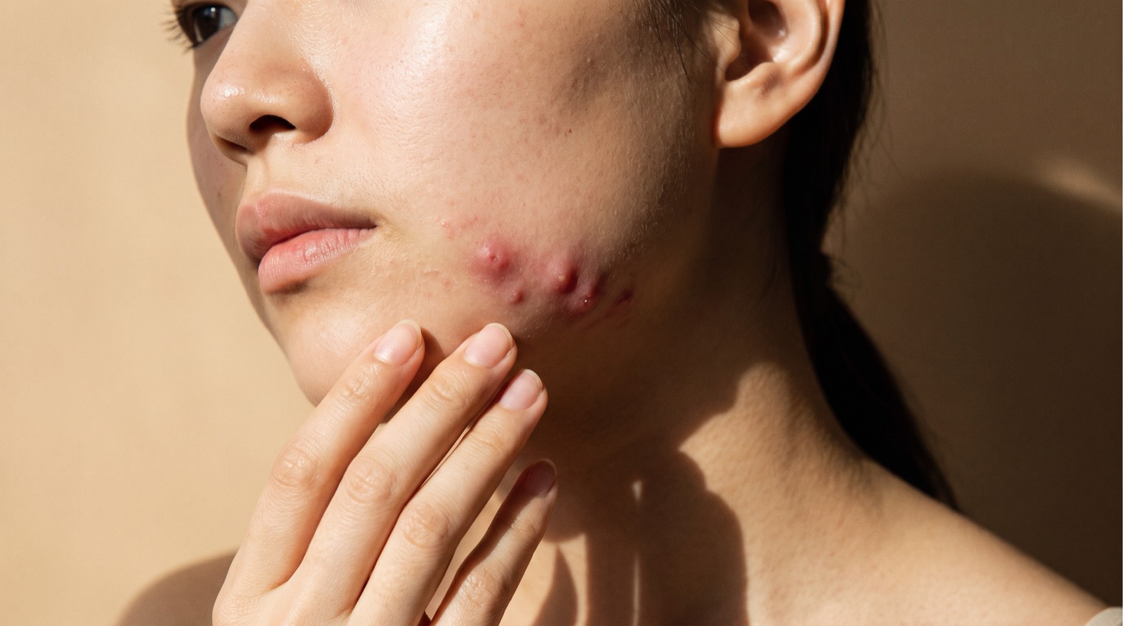 Cystic Acne: Why Deep, Painful Breakouts Need More Than Skincare