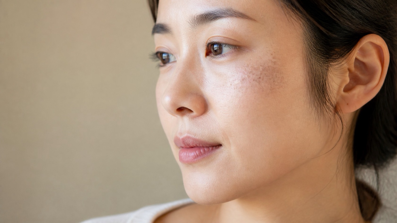 Hori's Naevus vs Melasma: Why Your Cheek Patches Might Not Be Melasma