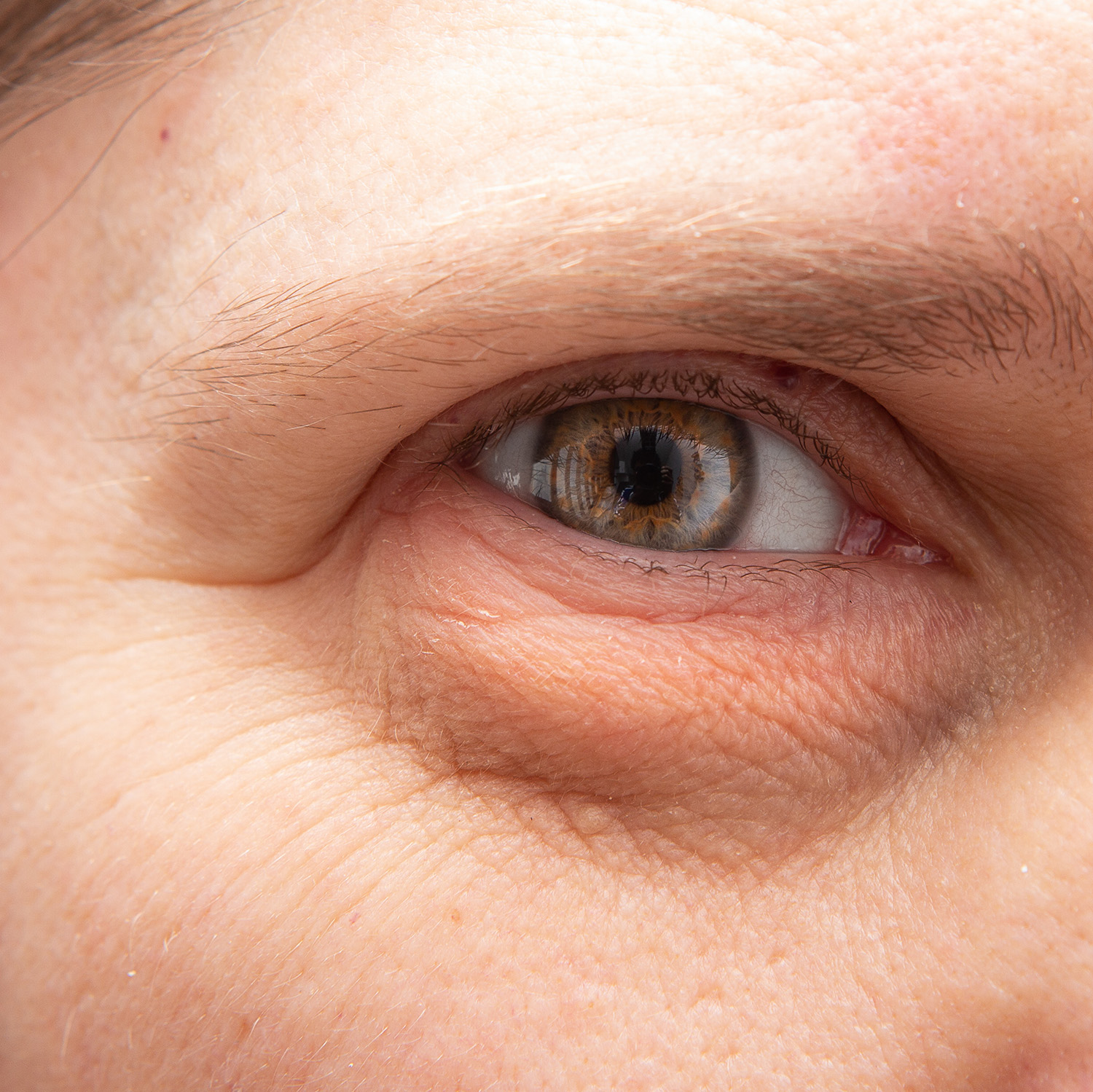 Expression lines & wrinkles