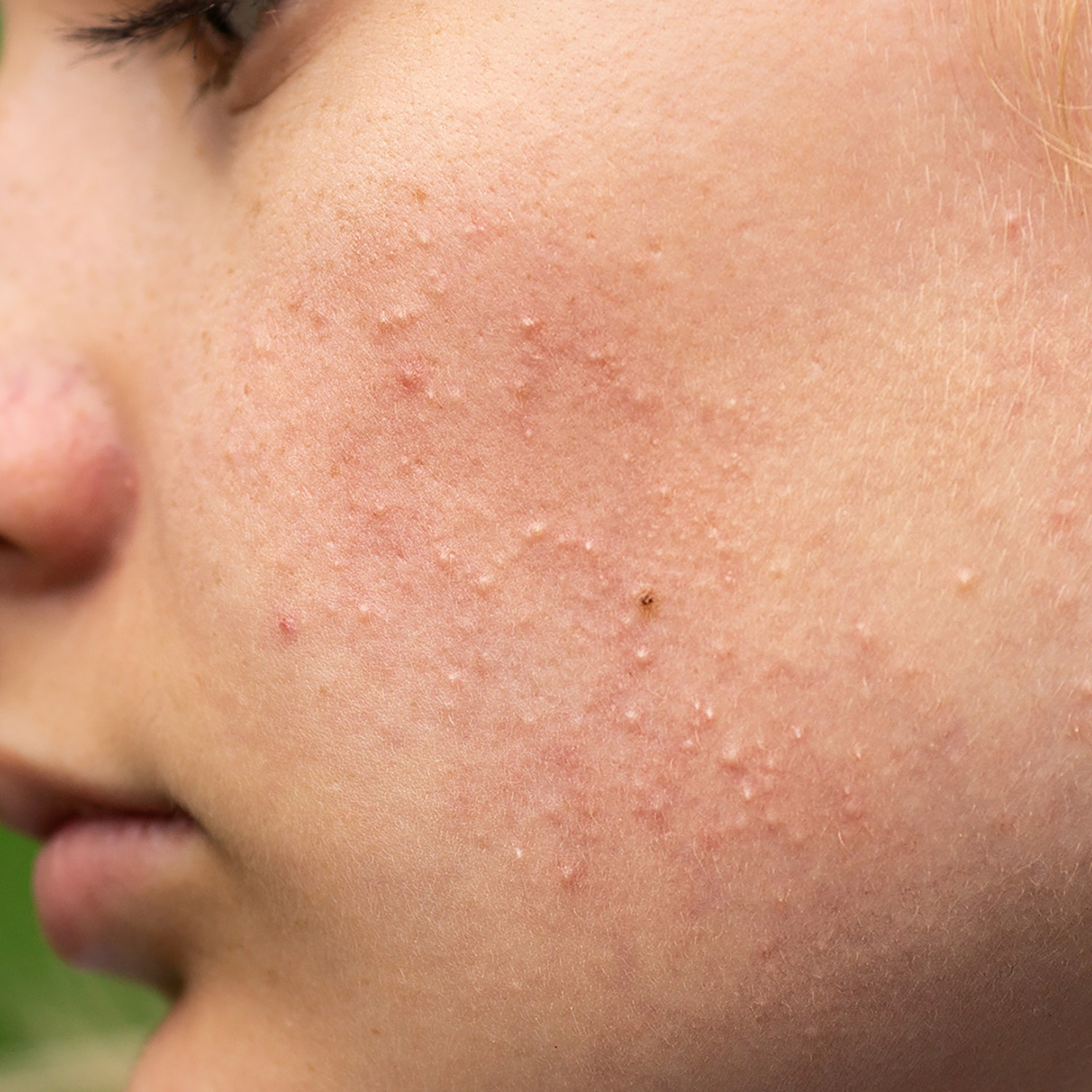 Comedonal Acne