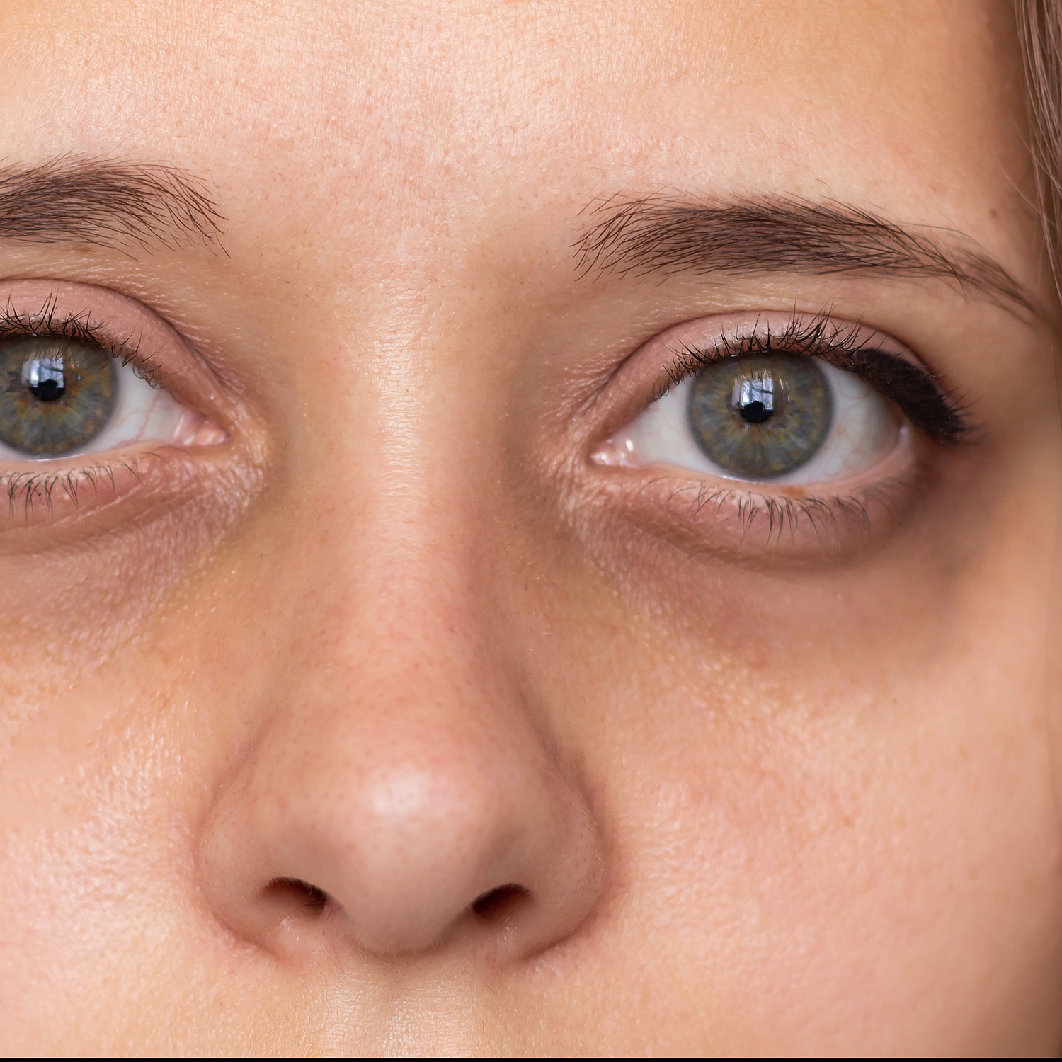Skin Pigmentation