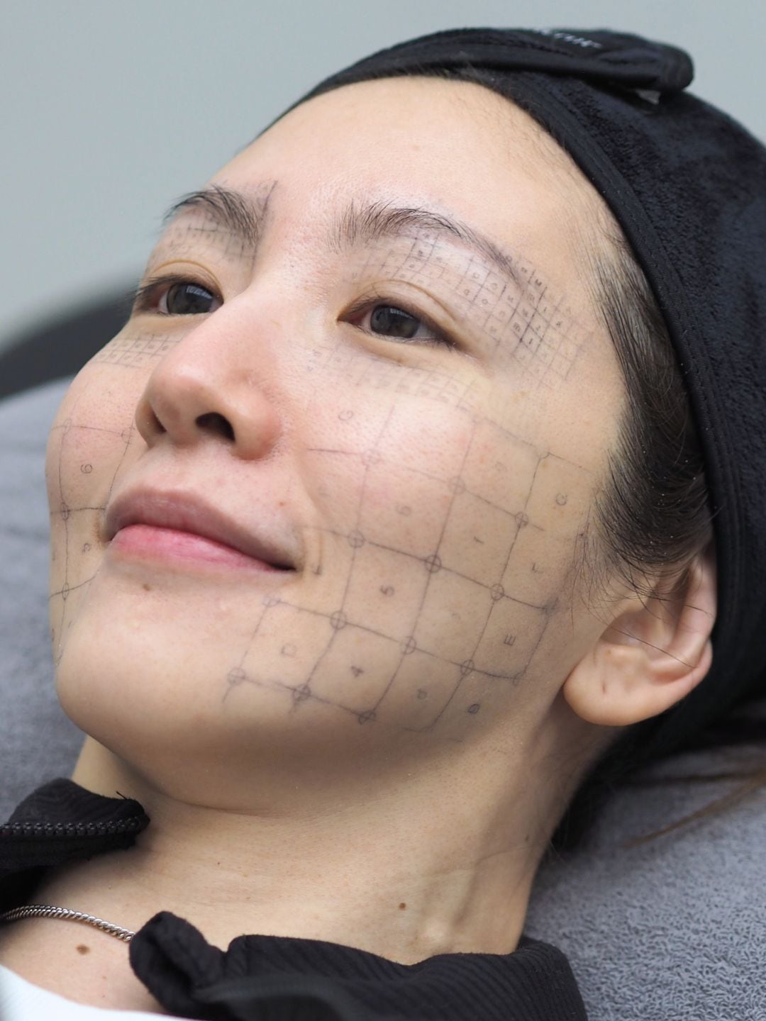 Density vs Thermage: An Honest Look at Two RF Skin-Tightening Options