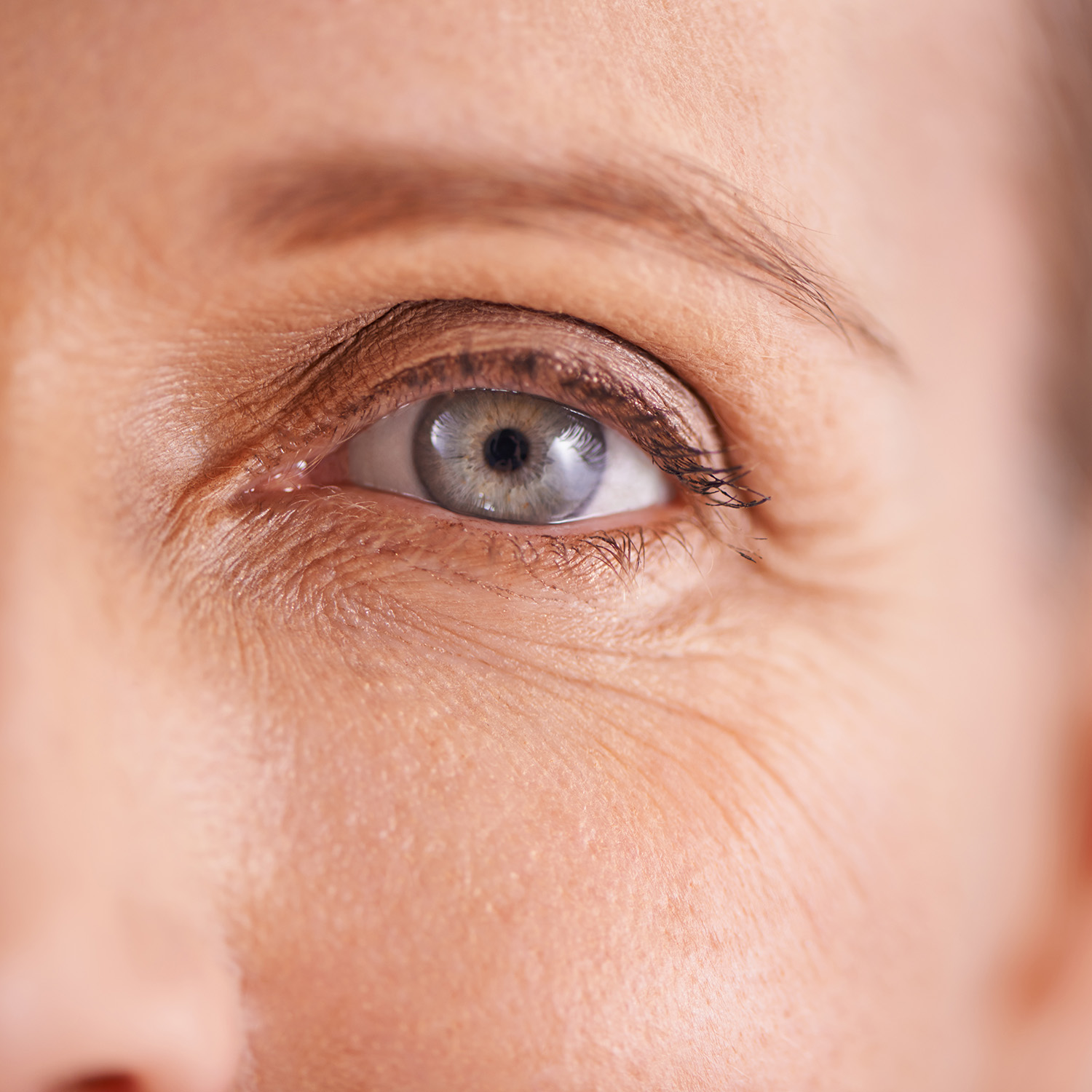 Fine lines & early laxity