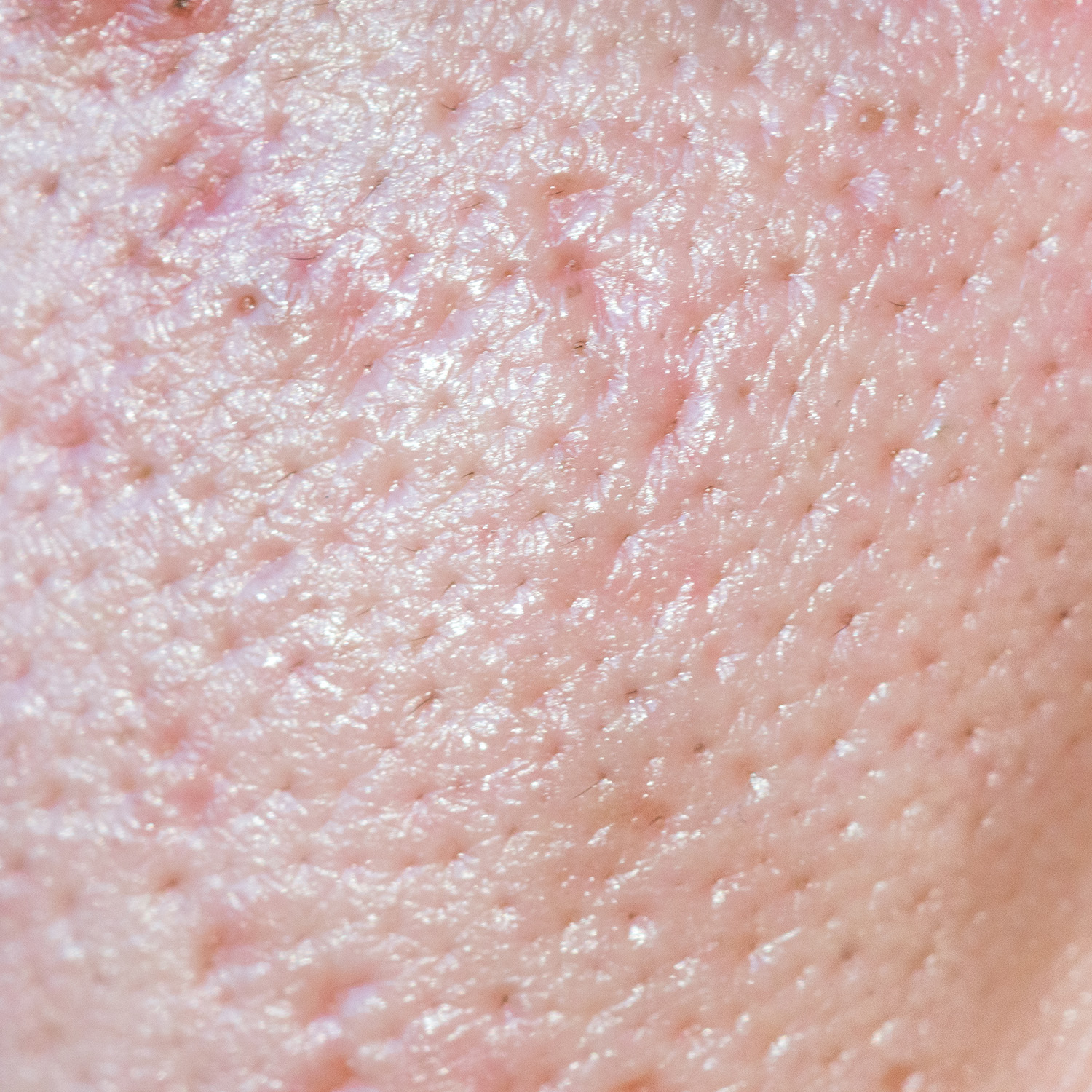 Fine lines & enlarged pores