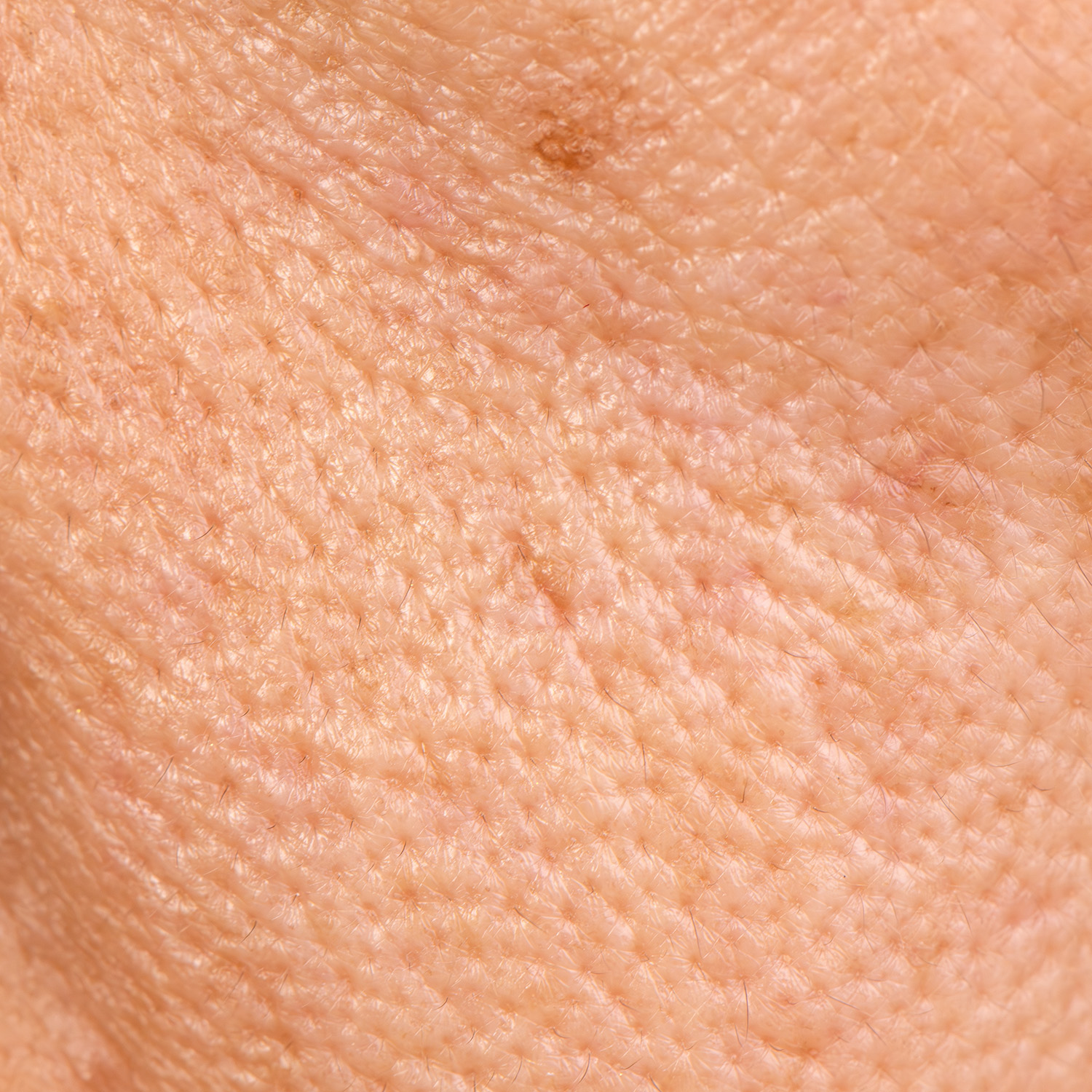 Loss of Skin Firmness