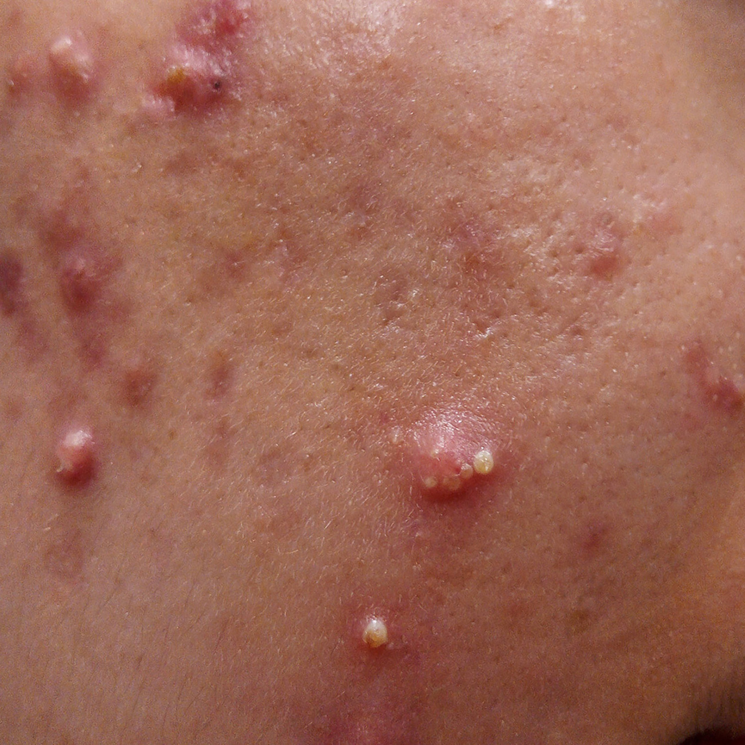Nodulocystic Acne
