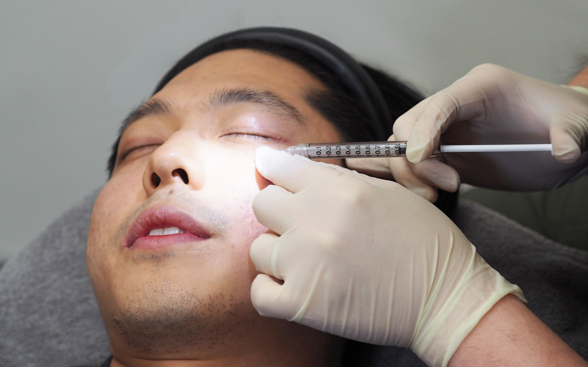 Panda Eye Dark Circle Injections