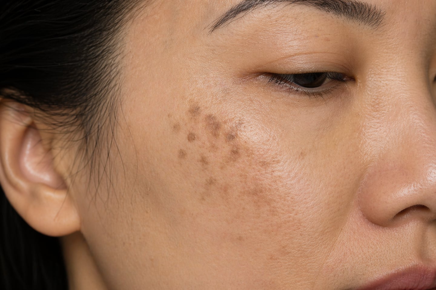 Close-up of bilateral slate-grey dermal pigmentation on a cheek