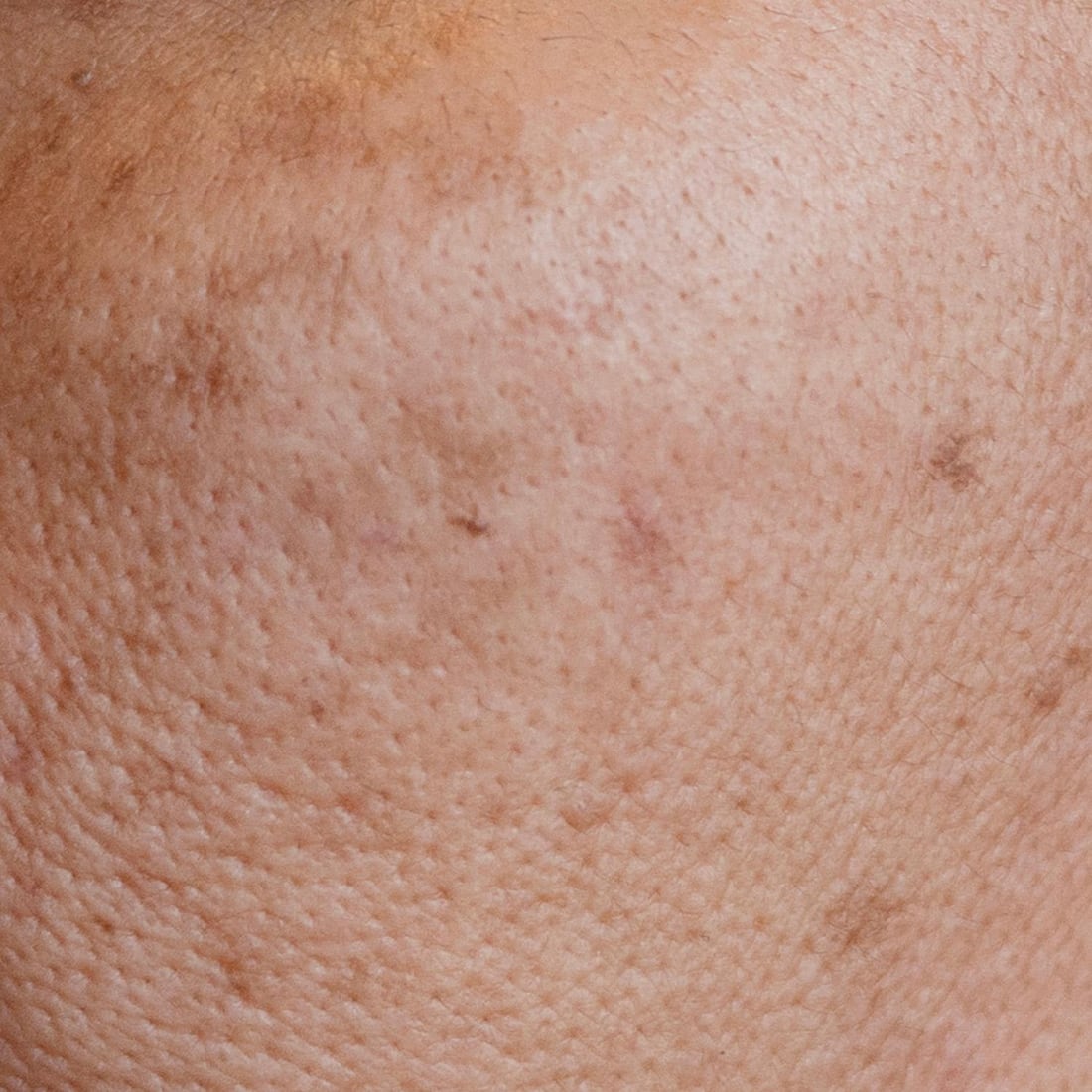 Close-up of flat brown post-inflammatory marks on a cheek