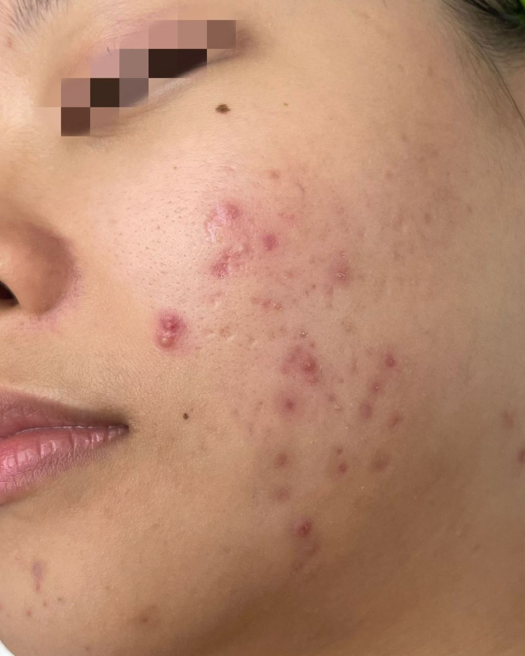 Before treatment