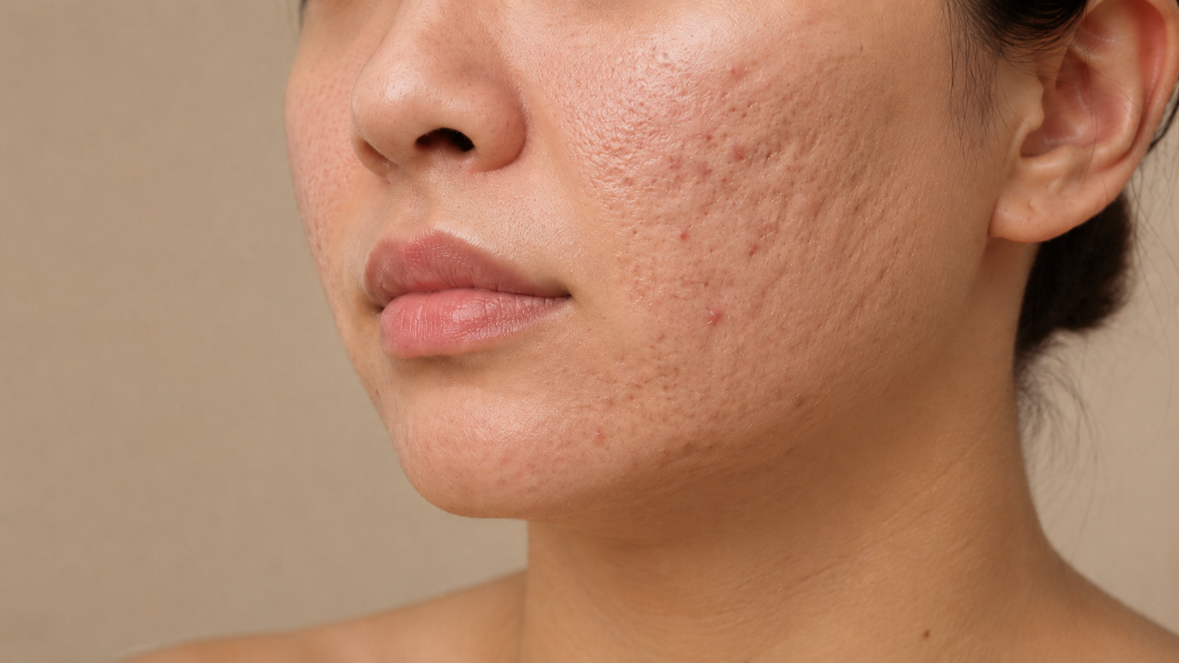 Acne scars & pitted scarring