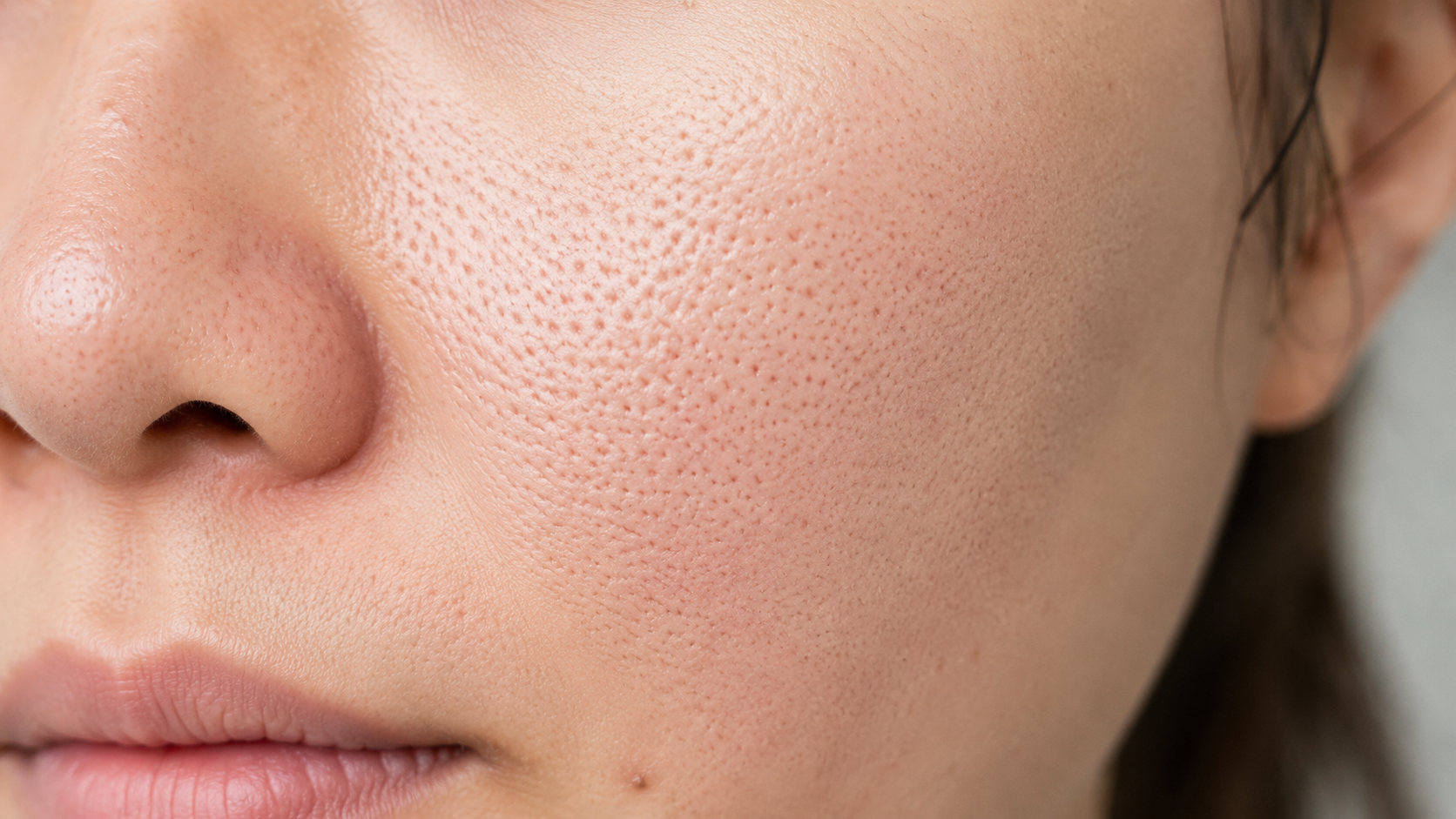 Enlarged pores