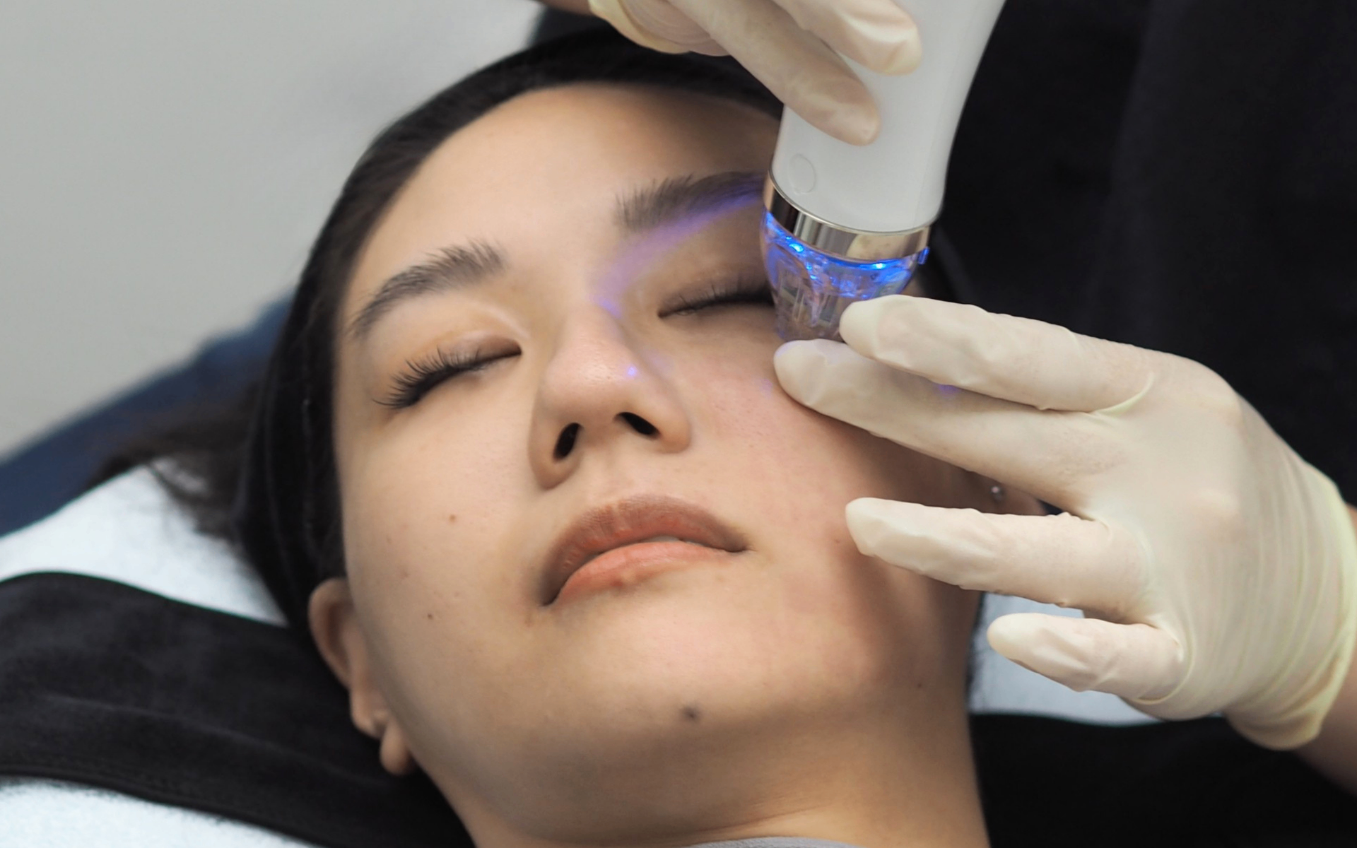 Regenesis RF Microneedling