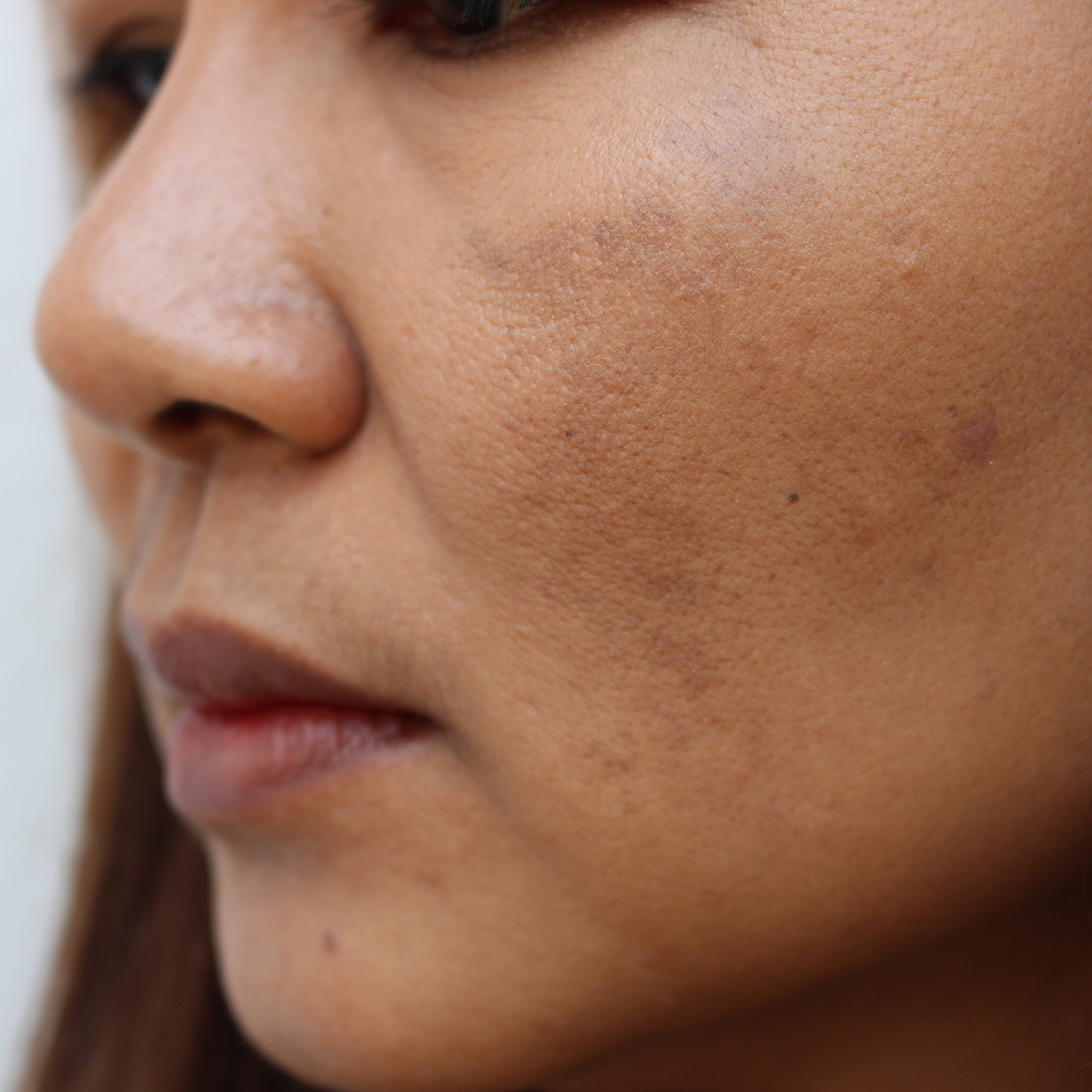 Dull, rough skin texture
